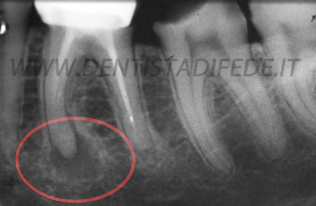 GRANULOMA IN ROSSO